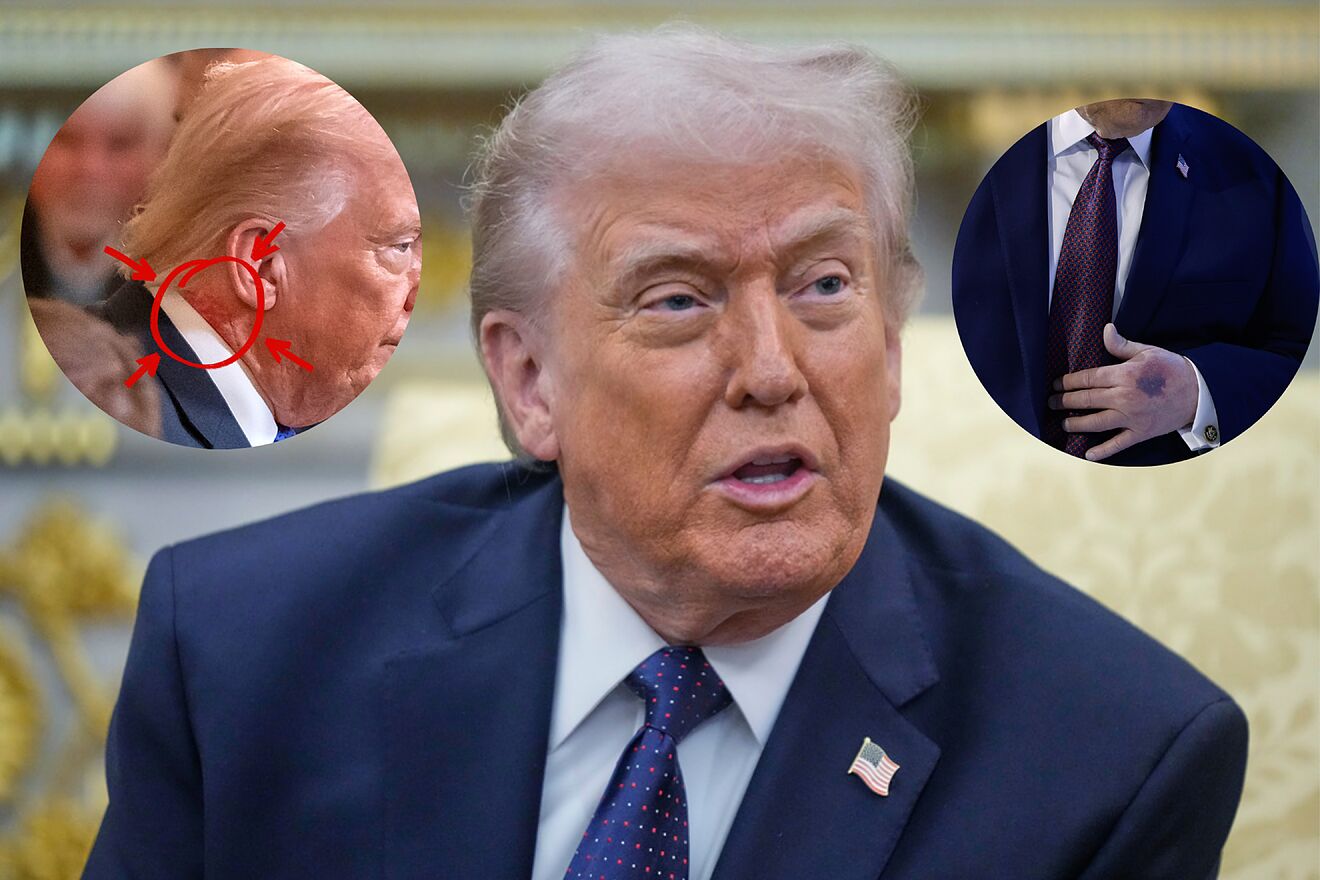 �Qu� es la insuficiencia venosa cr�tica y sus riesgos? As� es la...