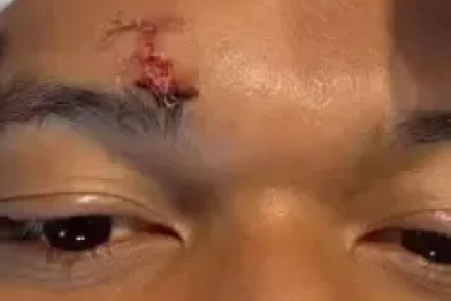 As� qued� la ceja de Mbapp� tras el golpe de Vitor Reis