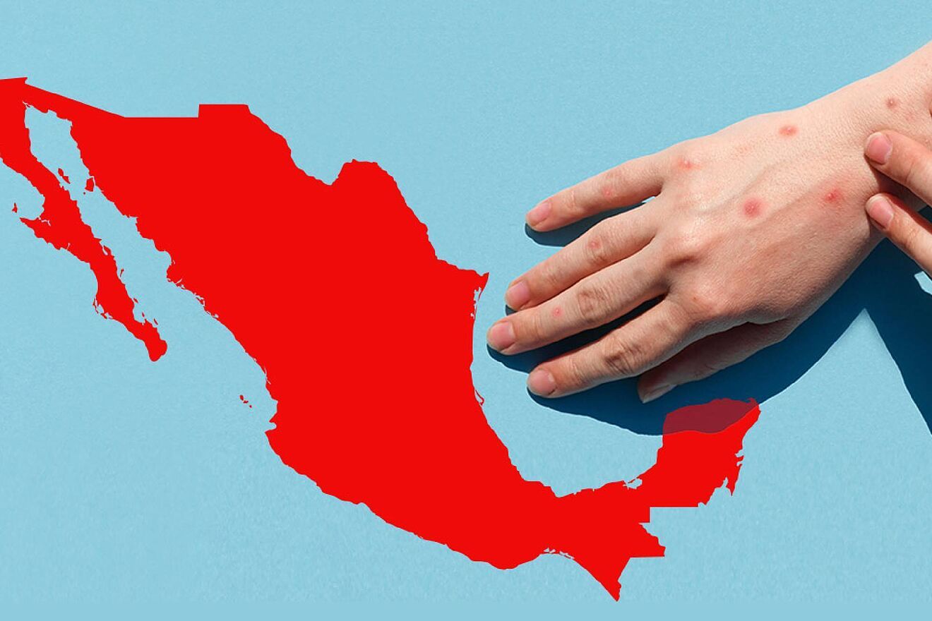 Sarampión: primeros síntomas, cómo no confundirlo con gripe y qué revisar en tu cartilla de vacunación